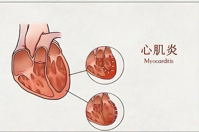 心肌炎的癥狀有哪些？心肌炎的主要變現癥狀有啥？